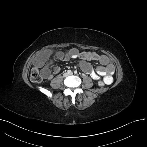 File:Closed loop small bowel obstruction - adhesions (Radiopaedia 59078-66369 A 76).jpg