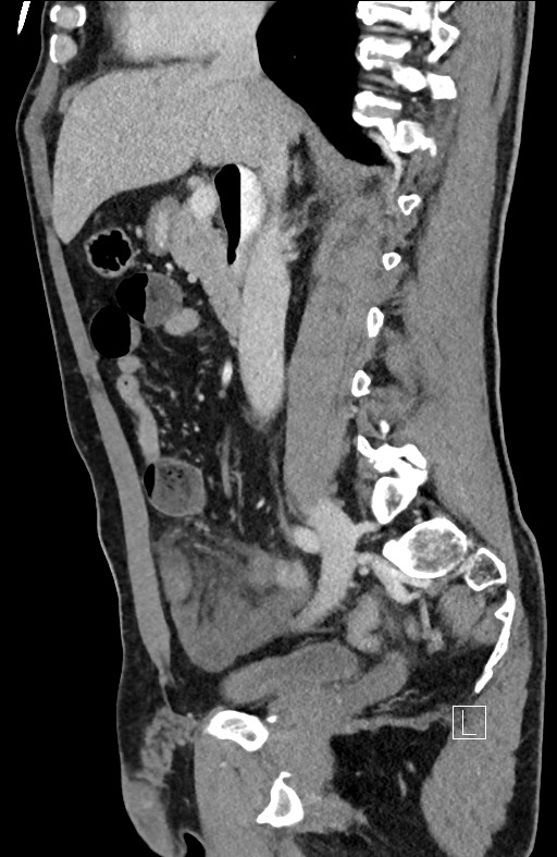 Closed loop small bowel obstruction - internal hernia (Radiopaedia 57806-64778 C 65).jpg