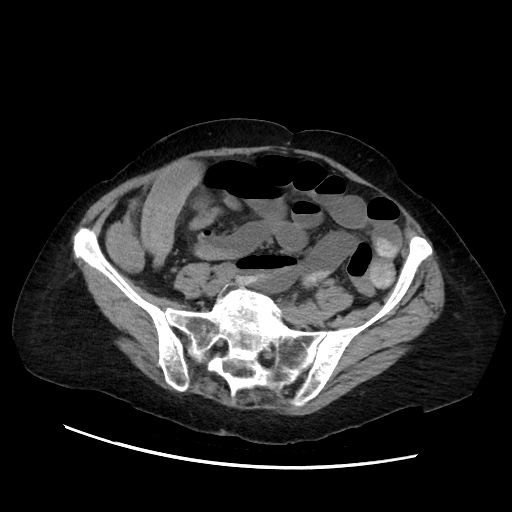 Closed loop small bowel obstruction due to adhesive band, with intramural hemorrhage and ischemia (Radiopaedia 83831-99017 Axial non-contrast 111).jpg