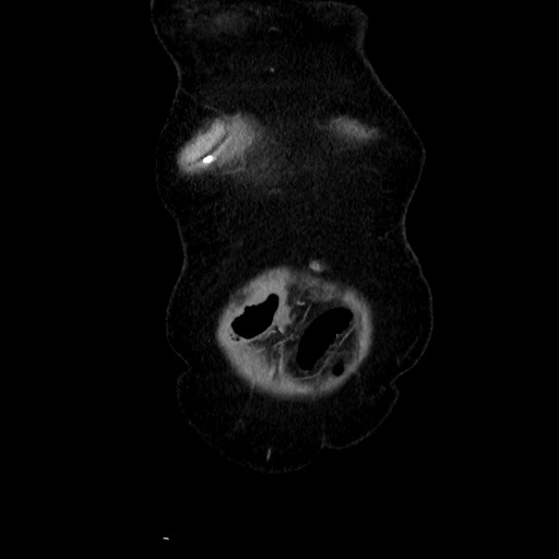 File:Closed loop small bowel obstruction due to adhesive band, with intramural hemorrhage and ischemia (Radiopaedia 83831-99017 C 16).jpg