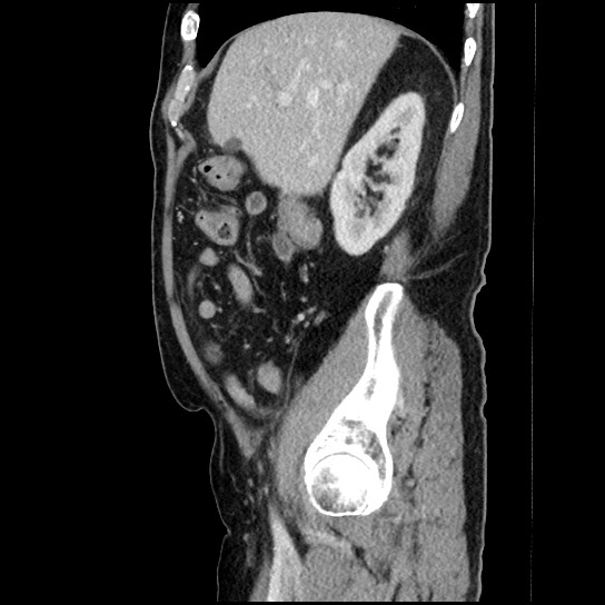 Closed loop small bowel obstruction due to adhesive band - U-shaped loop (Radiopaedia 83829-99012 C 52).jpg
