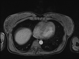 Closed loop small bowel obstruction in pregnancy (MRI) (Radiopaedia 87637-104031 Axial T1 fat sat 8).jpg