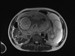 File:Closed loop small bowel obstruction in pregnancy (MRI) (Radiopaedia 87637-104031 Axial T2 37).jpg