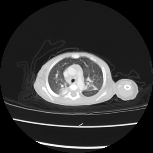 Coarctation of the aorta and patent ductus arteriosus (Radiopaedia 68033-77499 Axial lung window 14).jpg