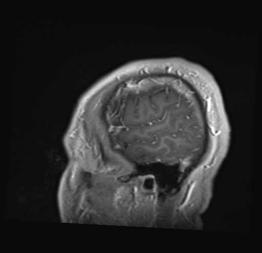 File:Cochlear incomplete partition type III associated with hypothalamic hamartoma (Radiopaedia 88756-105498 Sagittal T1 C+ 7).jpg
