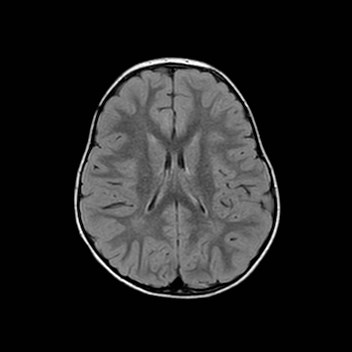 File:Cochlear nerve aplasia - unilateral (Radiopaedia 87910-104413 Axial FLAIR 22).jpg