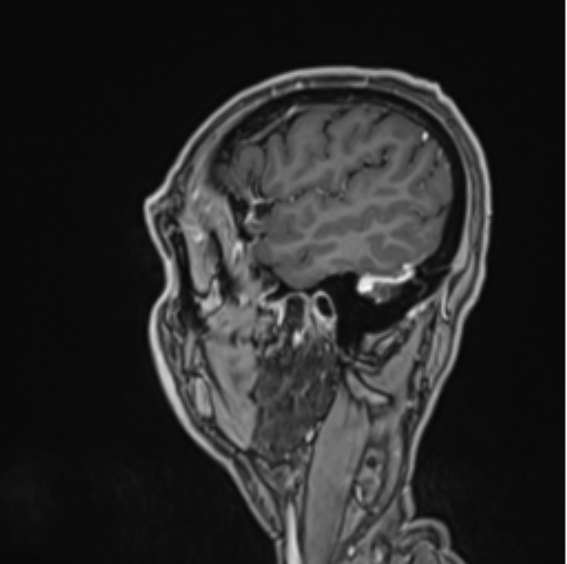 Colloid cyst of the third ventricle (Radiopaedia 86571-102662 Sagittal T1 C+ 13).png