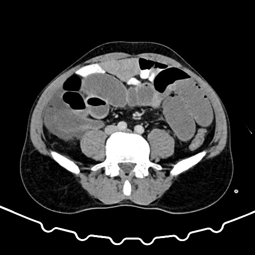 Colocolic intussusception due to large lipoma (Radiopaedia 68773-78482 A 121).jpg