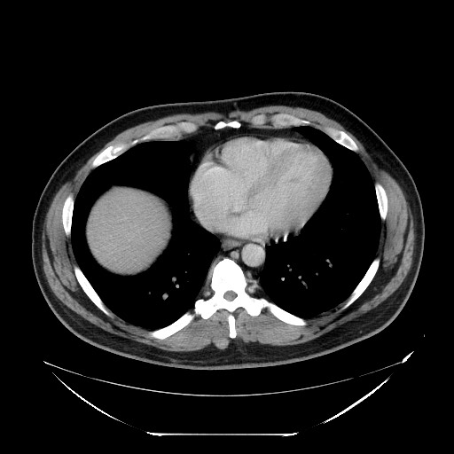 File:Colocolic intussusception due to lipoma (Radiopaedia 73712-84508 Axial 57).jpg