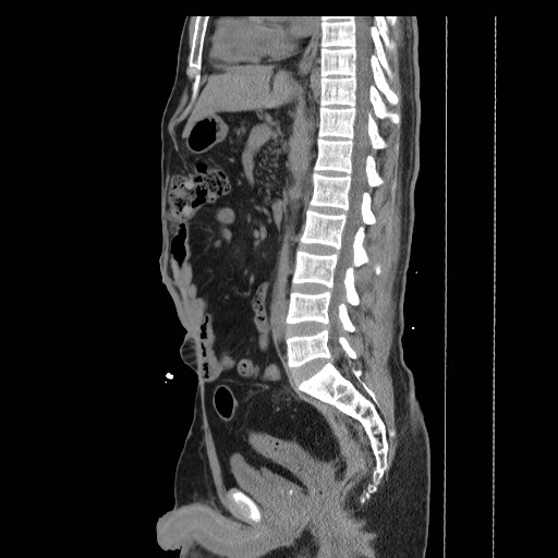 File:Colocutaneous fistula in Crohn's disease (Radiopaedia 29586-30093 C 23).jpg