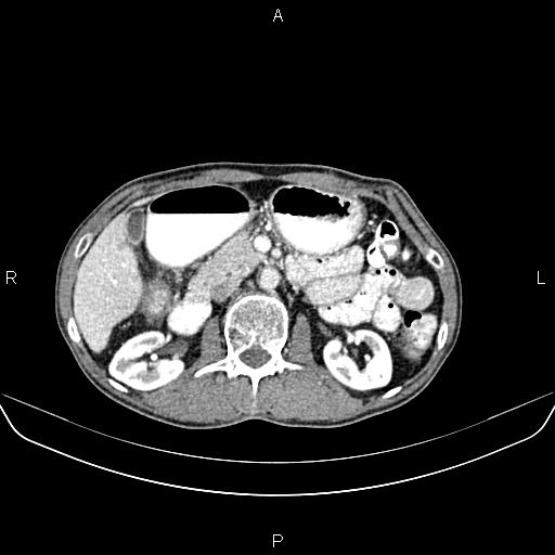 File:Colon adenocarcinoma - hepatic flexure (Radiopaedia 85635-101395 A 34).jpg