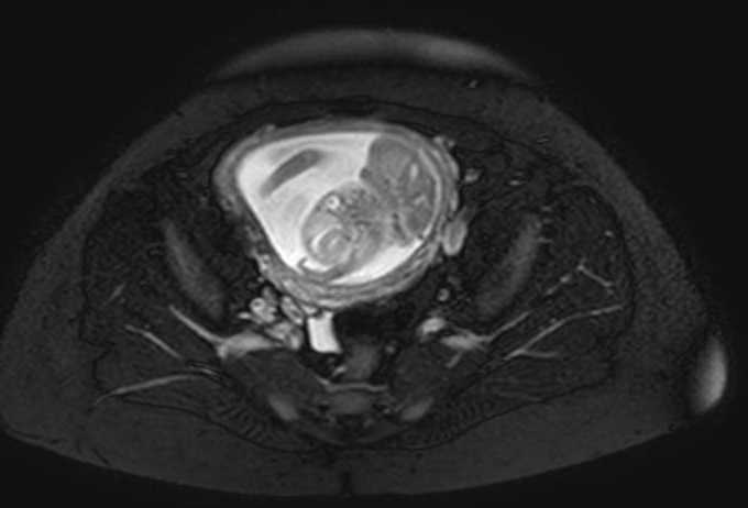 Colon adenocarcinoma with Krukenberg tumors, advanced pregnancy (Radiopaedia 67279-76645 Axial T2 SPAIR 16).jpg