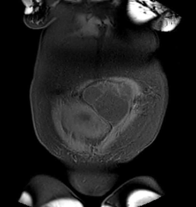 Colon adenocarcinoma with Krukenberg tumors, advanced pregnancy (Radiopaedia 67279-76645 E 6).jpg