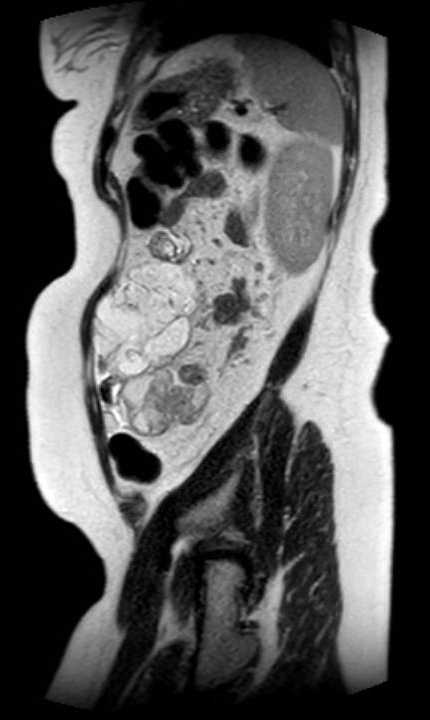 Colon adenocarcinoma with Krukenberg tumors, advanced pregnancy (Radiopaedia 67279-76645 Sagittal T2 13).jpg