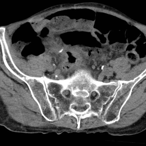 Colon cancer with calcified liver metastasis (Radiopaedia 74423-85309 Axial non-contrast 87).jpg