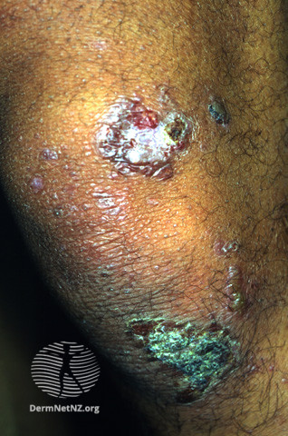 File:Epidermolysis bullosa acquisita (DermNet NZ immune-eba2).jpg