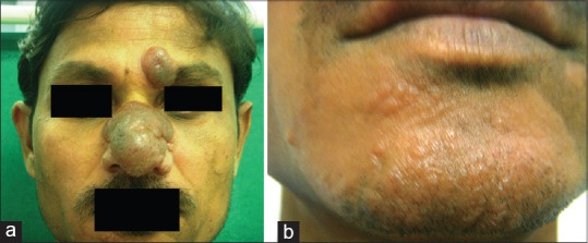 a) Image shows erythematous lobulated nodules b) hypopigmented plaque on chin