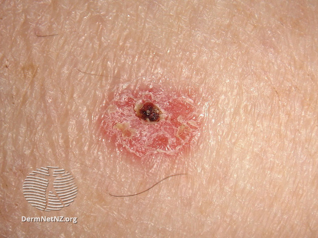 File:Intraepidermal carcinoma (DermNet NZ lesions-scc-in-situ-2947).jpg