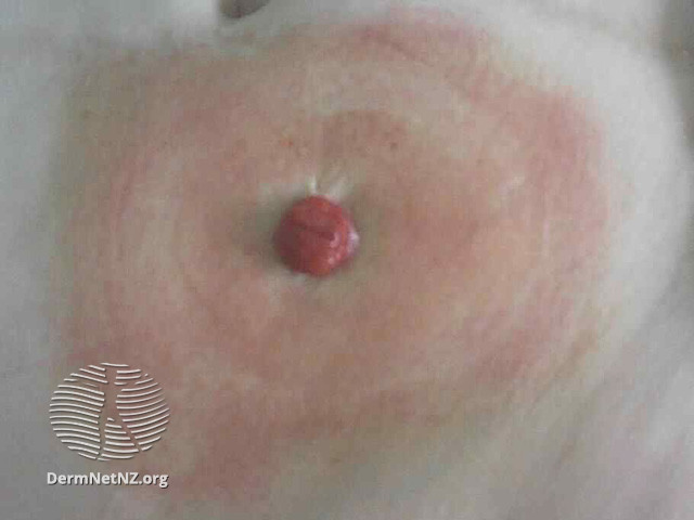 File:Irritant contact dermatitis (DermNet NZ reactions-stoma1).jpg