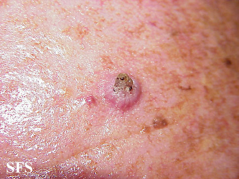 File:Keratoacanthoma (Dermatology Atlas 16).jpg
