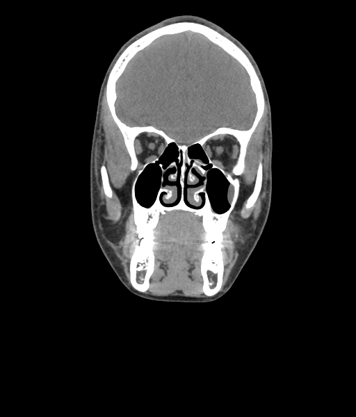 Nasal pyogenic granuloma (lobular capillary hemangioma) (Radiopaedia 85536-101244 Coronal non-contrast 90).jpg