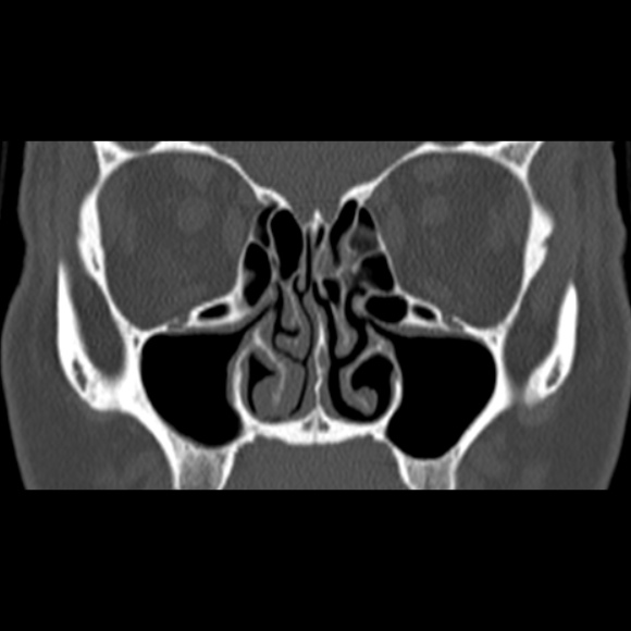 Nasal septal perforation (Radiopaedia 25030-25289 Coronal bone window 33).jpg