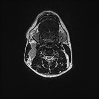 Nasopharyngeal carcinoma with perineural spread (Radiopaedia 55030-61380 Axial T2 51).jpg