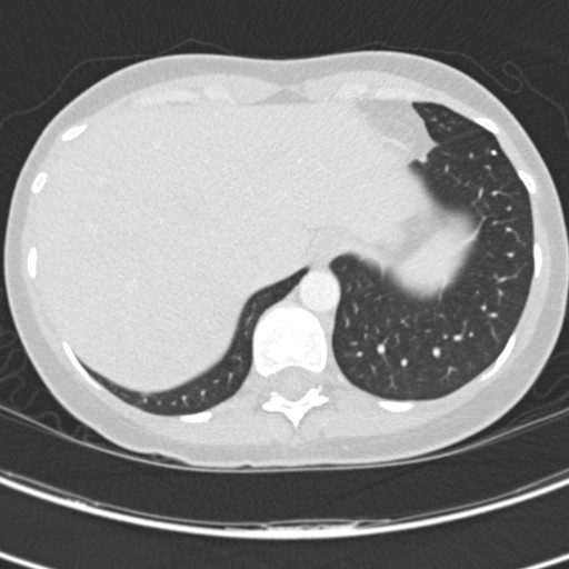 Necrobiotic pulmonary nodules - Crohn disease (Radiopaedia 20723-20631 Axial lung window 123).jpg