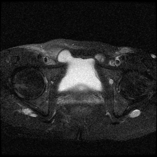File:Necrotizing epididymo-orchitis with intra-testicular abscess (Radiopaedia 29397-29860 Axial T2 fat sat 3).jpg
