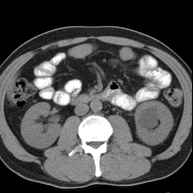 File:Necrotizing pancreatitis with acute necrotic collection (Radiopaedia 14470-14417 Axial non-contrast 24).jpg