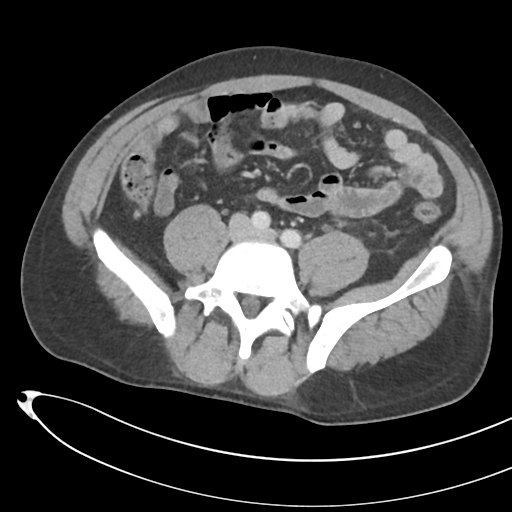 File:Necrotizing pancreatitis with acute necrotic collections (Radiopaedia 38829-41012 B 55).png