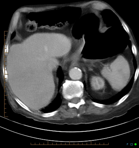 Necrotzing fasciitis due to a perforated adenocarcinoma of the splenic flexure (Radiopaedia 46930-51455 A 18).jpg