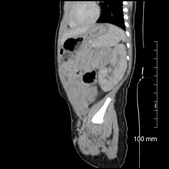 File:Neonatal neuroblastoma (Radiopaedia 56651-63438 C 30).jpg