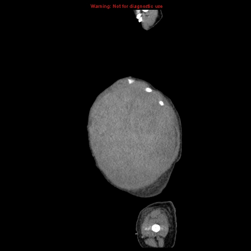File:Neonatal neuroblastoma (Radiopaedia 9564-10223 C 14).jpg