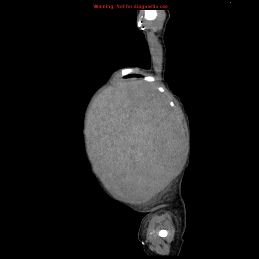 File:Neonatal neuroblastoma (Radiopaedia 9564-10223 C 20).jpg