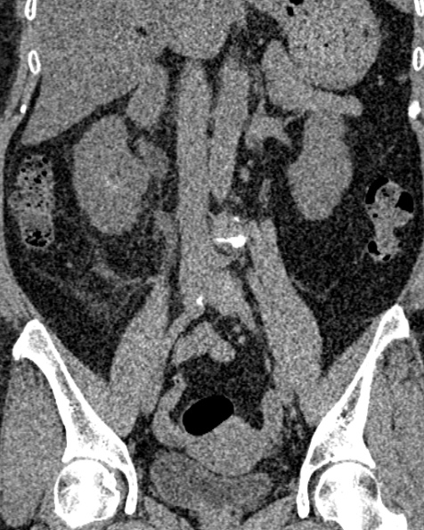 File:Nephrostomy for urosepsis (Radiopaedia 26180-26330 non-contrast 49).jpg