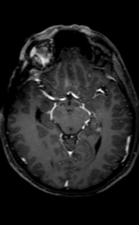 Neuro-Behçet disease (Radiopaedia 90112-107294 Axial T1 C+ 141).jpg