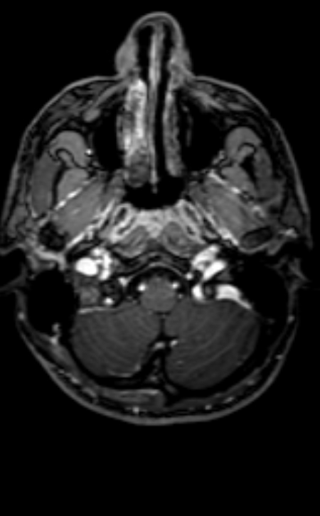 Neuro-Behçet disease (Radiopaedia 90112-107294 Axial T1 C+ 188).jpg