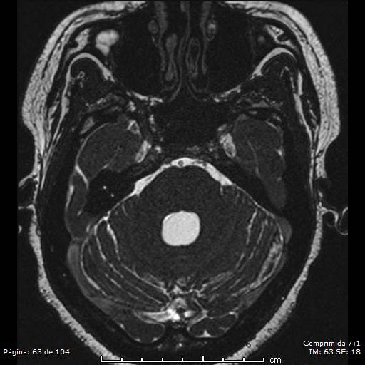 Neurocysticercosis (Radiopaedia 58636-65832 I 63).jpg
