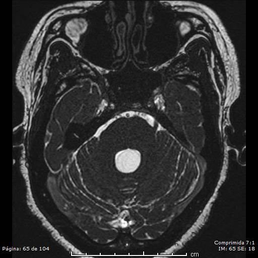 Neurocysticercosis (Radiopaedia 58636-65832 I 65).jpg