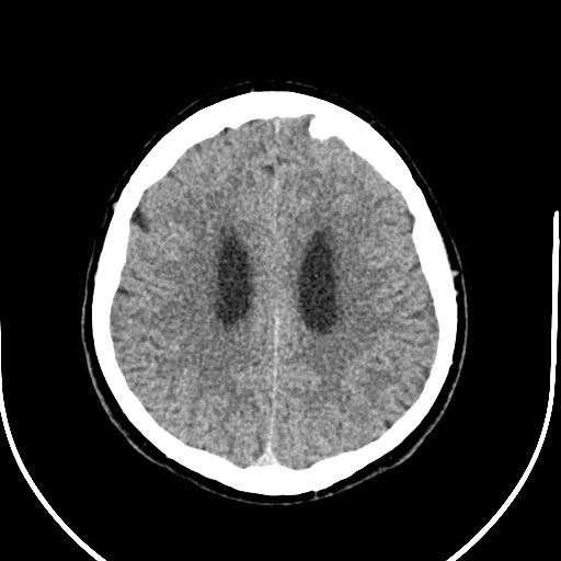 Neurofibromatosis type 2 (Radiopaedia 79097-92047 Axial non-contrast 43).jpg
