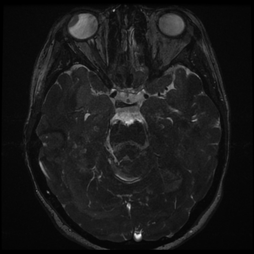 Neurofibromatosis type 2 - bilateral acoustic neuromata (Radiopaedia 40060-42566 Axial FIESTA 77).png