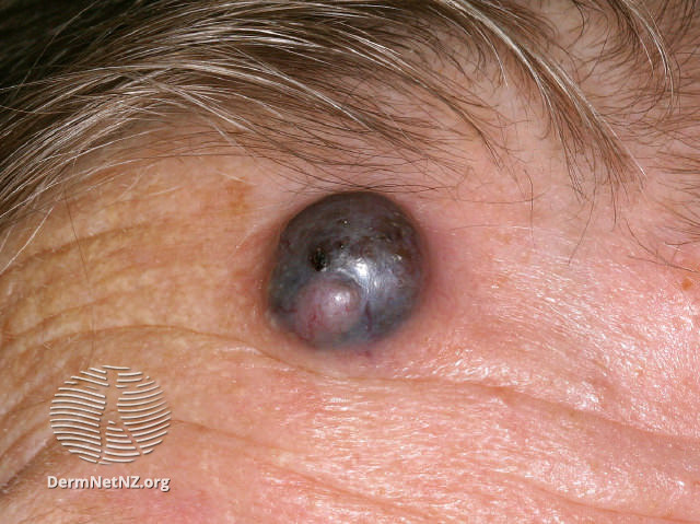 File:Nodular melanoma (DermNet NZ nm4).jpg