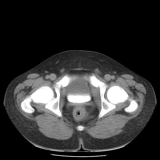 File:Non-Hodgkin lymphoma involving pelvis (Radiopaedia 21281-21197 B 60).jpg