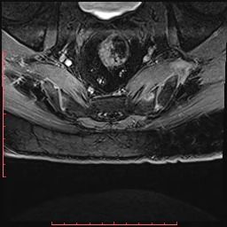 Non Hodgkin's lymphoma with metastasis to spine (Radiopaedia 54844-61103 Axial T1 C+ fat sat 46).jpg