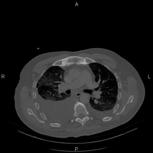 Non Hodgkin lymphoma in a patient with ankylosing spondylitis (Radiopaedia 84323-99624 Axial bone window 13).jpg