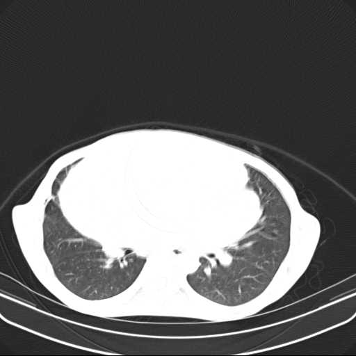 File:Non hodgkin lymphoma of the mediastinum (Radiopaedia 20814-20729 Axial lung window 27).jpg