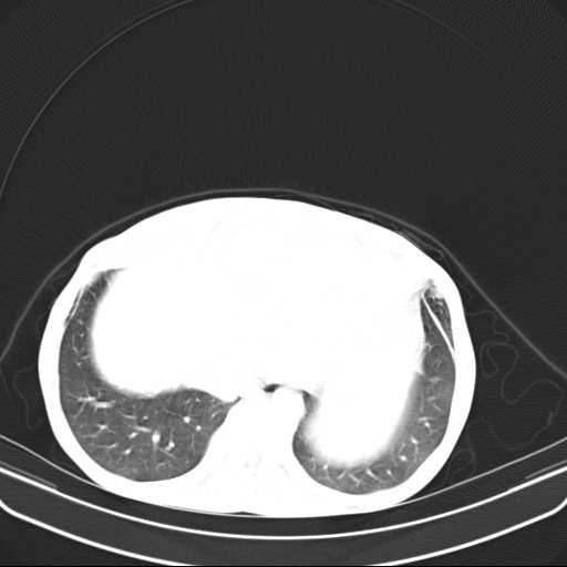 File:Non hodgkin lymphoma of the mediastinum (Radiopaedia 20814-20729 Axial lung window 45).jpg
