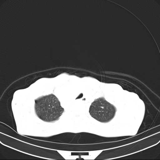 File:Non hodgkin lymphoma of the mediastinum (Radiopaedia 20814-20729 Axial lung window 9).jpg