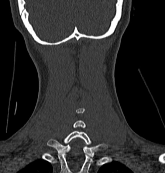 File:Normal CT cervical spine - 12-year-old (Radiopaedia 55352-61775 Coronal bone window 193).jpg